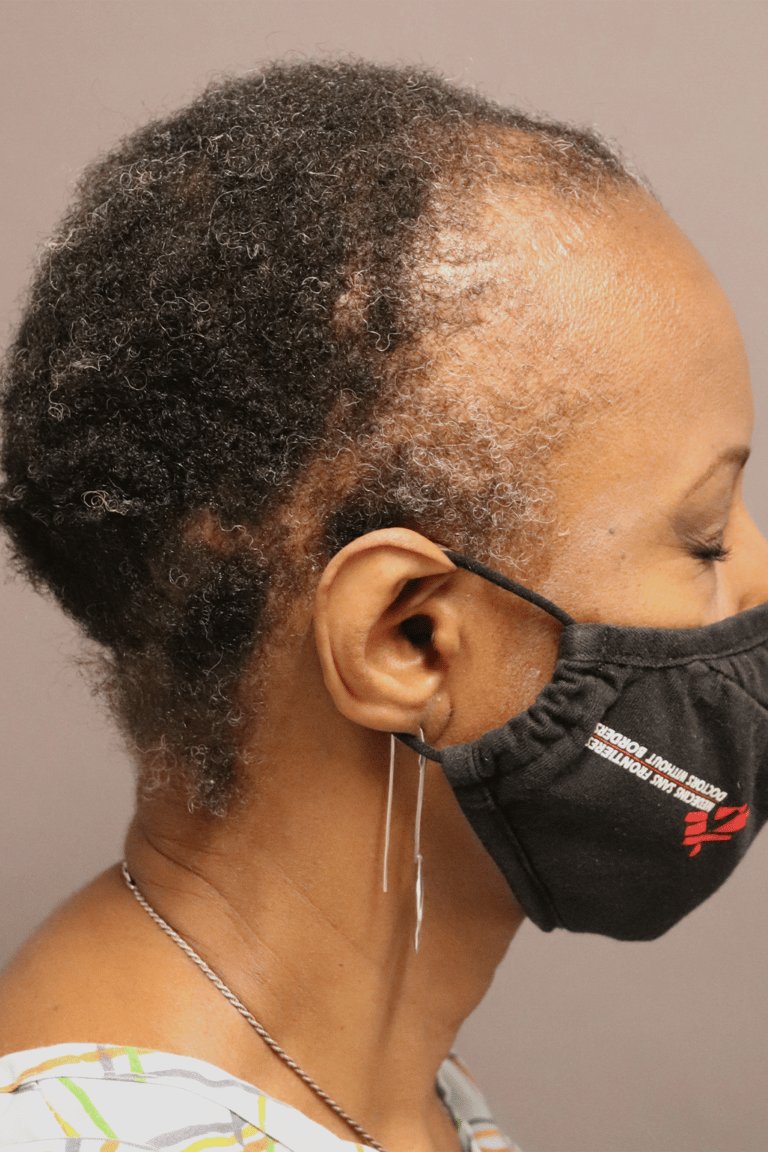 Before Image: Female DHI - left-side