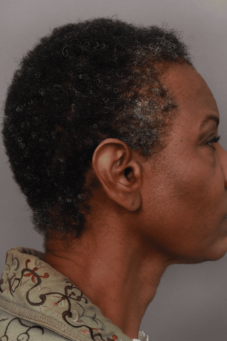 After Image: Female DHI - left-side