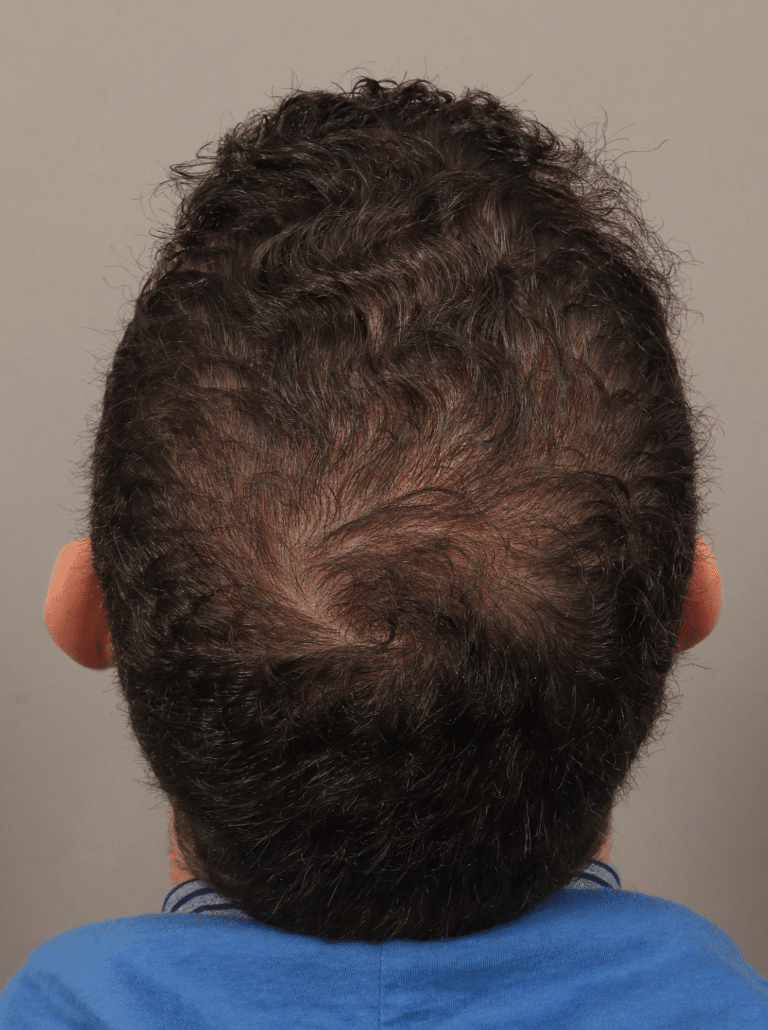 After Image: Male NeoGraft (9 Months Post-op) - back